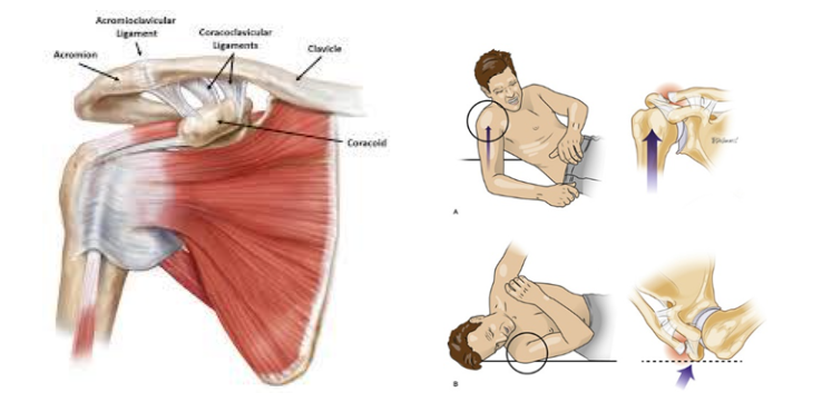 Internal image of AC joint
