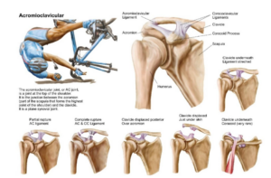 Acromioclavicular joint injury